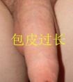什么是包皮过长、包茎?
