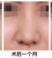 隆鼻术后到底会肿多久?多久才会自然?