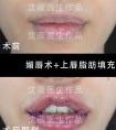 薄唇女孩难道不配拥有M唇吗?