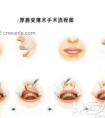 不敢做厚唇改薄术是担心术后一年又会变厚