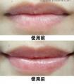 徐州薄唇变厚的效果如何?