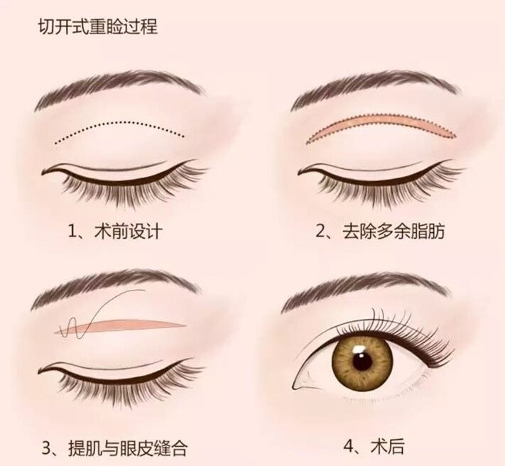 双眼皮埋线好还是割好 有什么不一样