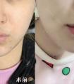 怎么让厚嘴唇变薄呢?