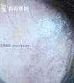 爱美需谨慎!一针小小玻尿酸竟造成女子脸部变紫