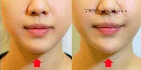 玻尿酸<a href='/tag_dianxiabaduoshao.html'>垫下巴多少钱</a>一针要几支才定型？玻尿酸垫下巴多久恢复自然