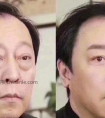 独家秘笈!威海除眼袋的最好方法!
